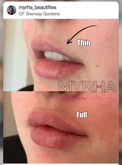 Lip Fillers Round, Lip Filler Bottom Lip Bigger, Angelic Lip Filler, Lip Filler Downturned Lips, Pillow Lips Injections, Lip Injection Inspiration, Lip Filler Shape Ideas Pouty, Lip Fillers Before And After 1ml Russian, Celebrity Lip Fillers