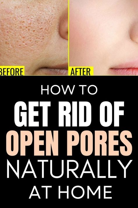 Effective Home Remedies To Get Rid Of Open Pores
Here, we'll go over several tried-and-true methods for reducing the appearance of your pores without resorting to any drastic measures that might compromise your skin's health or your wallet. Open Pores On Face, Pores On Face, Skin Care Procedures, Lotion For Oily Skin, Face Pores, Open Pores, Spots On Face, Moisturizer For Oily Skin, Large Pores