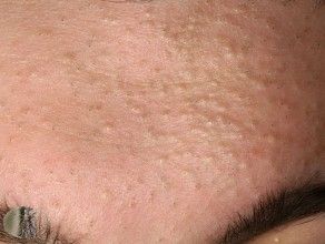 Comedonal Acne, Sebaceous Filaments, Blind Pimple, Clear Blackheads, Medical Words, Fat Burning Tea, Human Body Art, Acne Vulgaris, Acne Causes