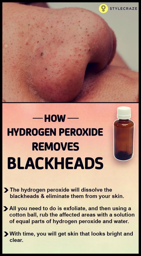 Black Heads, Get Rid Of Blackheads, Natural Cough Remedies, Hydrogen Peroxide, Natural Home Remedies, Health And Beauty Tips, Skin Tips, Blackhead Remover, The Skin