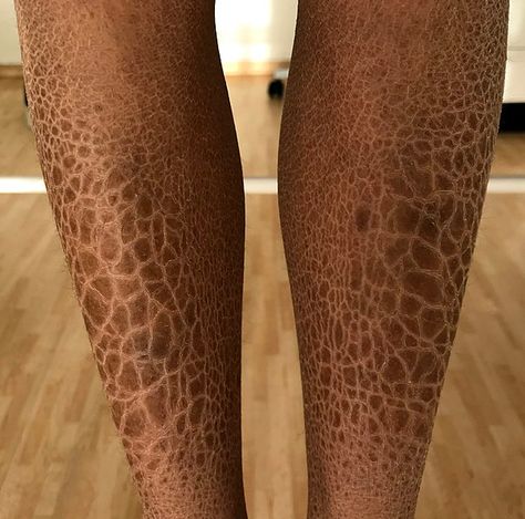 Holes In Skin Phobia, Trypophobia Skin, Ichthyosis Vulgaris, Scale Skin, Womens Health Care, Scaly Skin, Be With You Movie, Theatrical Makeup, Real Bodies