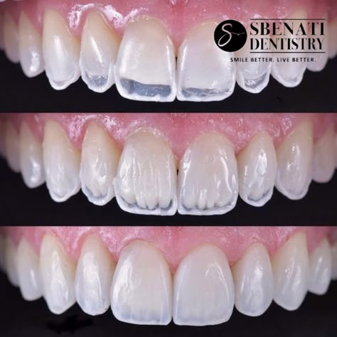 Pretty Teeth, Dental Videos, Veneers Teeth, Aesthetic Dentistry, Beautiful Teeth, Dental Fillings, Dental Braces, Perfect Teeth, Dental Laboratory