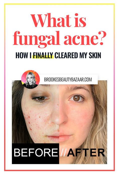 what is fungal acne? malassezia is actually a fungus that feeds on certain ingredients in your skincare and makeup products.. yikes! Unchecked, this fungus will spread over your face & body, causing a bumpy skin-tone rash (forehead bumps), or even worse - acne pustules! Luckily it's treatable without harsh chemicals or harmful medications. Find out how to get clear, glowing skin free from fungal acne on the blog.. #fungalacne #malassezia #acne #clearksin Acne On Forehead Reasons For, Acne Safe Blush, Fungal Acne Safe Products, Fungle Acne, Bumpy Forehead, Treat Fungal Acne, Forehead Breakout, Bacterial Acne, Makeup For Acne