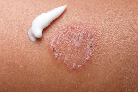 ringworm and cream Skin Rashes Pictures, Antifungal Cream, Natural Remedies For Migraines, Skin Rashes, Allergy Remedies, Dry Skin Remedies, Home Remedies For Hair, Toenail Fungus, Coconut Oil Hair