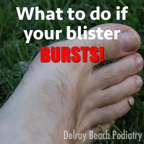 How To Treat Blisters, Blister Care, Blood Blister, Heel Blisters, Epidermolysis Bullosa, Blue Makeup Looks, Skin Diseases, Foot Health, Delray Beach