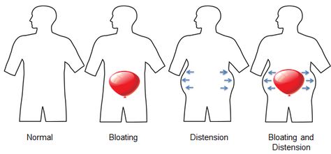 bloating and distension Lumbar Lordosis, Slim Stomach, Small Intestine Bacterial Overgrowth, Chronic Constipation, Gastrointestinal Disorders, Bloated Belly, Health Questions, Cognitive Behavioral Therapy, Nutrition