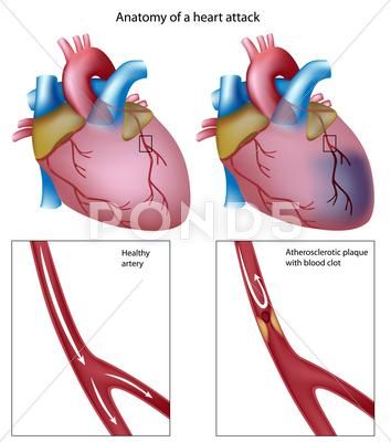 Heart attack Stock Illustration #AD ,#attack#Heart#Illustration#Stock What Is Cholesterol, Cholesterol Symptoms, Medical Intuitive, Cholesterol Medications, Cholesterol Remedies, Cholesterol Lowering Foods, Hdl Cholesterol, Healthy Cholesterol Levels, Heart Muscle