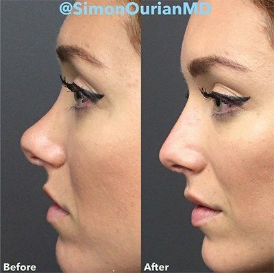 The Truth About Those 5-Minute Nonsurgical Nose Jobs That Have Everyone Freaking Out Nonsurgical Nose Job, Nose Surgery Rhinoplasty, Nose Fillers, Bulbous Nose, Plastic Surgery Fail, Nose Jobs, Rhinoplasty Nose Jobs, Plastic Surgery Gone Wrong, Hyaluronic Acid Fillers