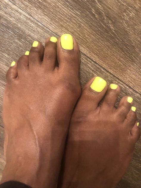 Ugly Feet Pedicure, Feet Pedicure, Fingernails Painted, Foot Pedicure, Pedicure Designs, Toenail Polish, Foot Care, Manicure Pedicure, Lemon Juice