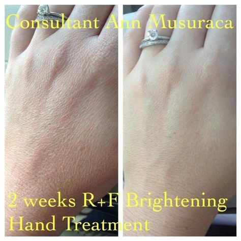 Wrinkles Hands, Mask For Oily Skin, Dry Skin Remedies, Life Changing Skincare, Crepey Skin, Dark Spots On Skin, Best Skin Care Routine, After Photos, Rodan And Fields