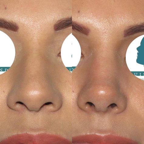 Nose Plastic Surgery, Nose Surgery Rhinoplasty, Ethnic Rhinoplasty, Nose Fillers, Nose Jobs, Rhinoplasty Nose Jobs, Botox Lips, Job Inspiration, Pretty Nose