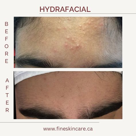 Skin Transformation Before And After, Cryo Facial Before And After, Hydrafacial Before And After, Zerona Laser Before And After, Face Fillers Before And After Jaw, Hydroquinone 4% Before And After, Hydra Facial, Skin Clinic, Skin Treatments