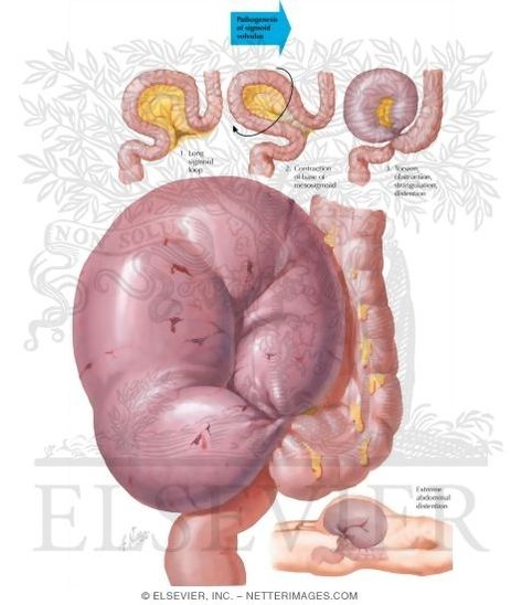 Volvulus of the Sigmoid Medical Radiography, Sigmoid Colon, Radiology Technologist, Human Body Anatomy, Body Anatomy, Medical Field, Anatomy, Human Body, Medical