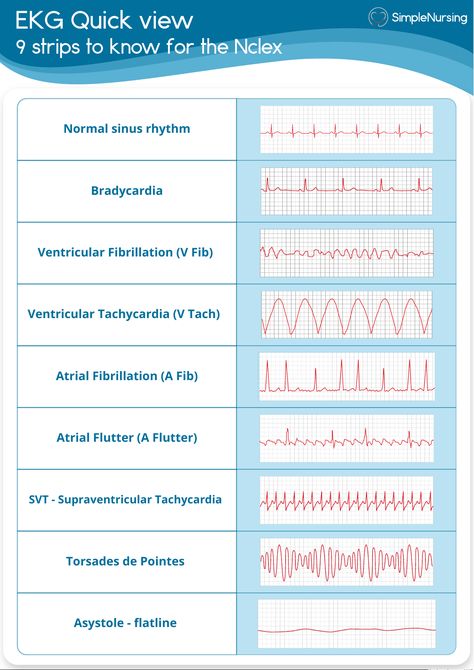 EKG : ECG - Simple Nursing - Heart Sounds & 5 EKG Lead Placement Heart Sounds AORTIC ( nd - Studocu Ekg Lead Placement, Intercostal Space, Ekg Placement, Lead Placement, Simple Nursing, Ekg Interpretation, Coran Quotes, Nursing School Essential, Heart Sounds