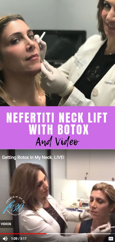 Botox Neck Before After, Neck Botox Before And After, Botox In Neck, Jaw Botox Before After, Neck Lift Before And After, Botox For Nose Tip, Places To Get Botox On Face, Benefits Of Botox Anti Aging, Botox Training For Nurses