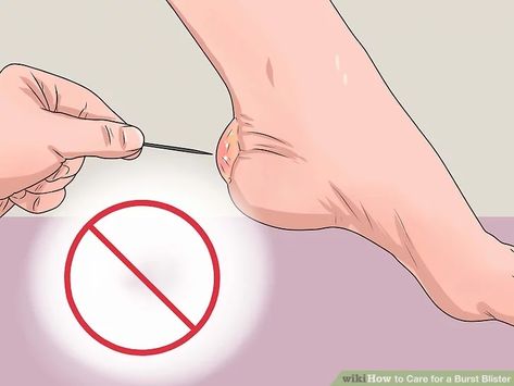 How to Care for a Burst Blister (with Pictures) - wikiHow Heal Blisters, How To Heal Blisters, Soothing Face Mask, First Aid Tips, Layers Of Skin, First Aid, Your Skin, Healing, Heat