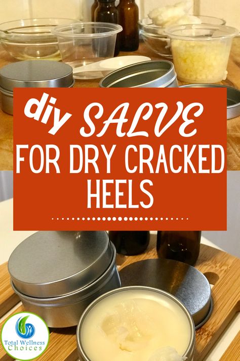 Cracked Heels Remedy, Cracked Heels Diy, Homemade Foot Cream, Diy Salve, Cracked Heel Remedies, Homemade Balm, Homemade Salve, Dry Cracked Heels, Dry Heels