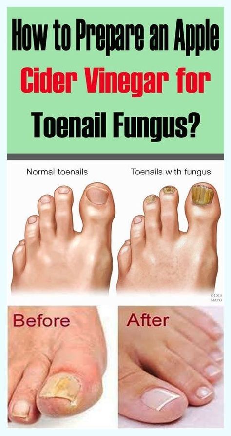 Get Rid Of Nail Fungus Forever With 2 Natural Ingredient Toenail Fungal Infection, Nail Remedies, Nail Conditions, Toenail Fungus Remedies, Nail Fungus Remedy, Fungal Nail, Ingrown Toe Nail, Toenail Fungus, Fungal Infection