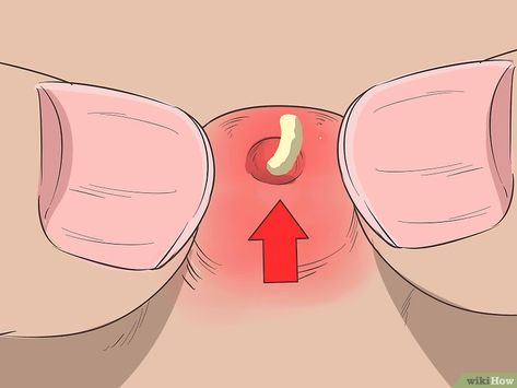 How to Instantly Get Rid of a Pimple (Cotton Ball Popping Method) Cheek Pimples, Pimples On Buttocks, Banana Mask, Cystic Pimple, Blind Pimple, Pimples Under The Skin, Zits Popping, Prevent Pimples, How To Get Rid Of Pimples