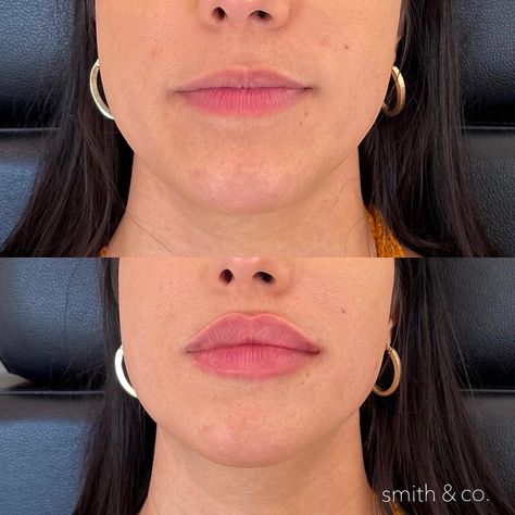 Simple Lip Fillers, Lip Filler Examples, Healed Lip Filler, Lip Filler Inspo Natural, Lip Fillers Heart Shape, Different Types Of Lip Fillers, 1ml Of Lip Filler, Lip Goals Natural, Flat Lips Filler