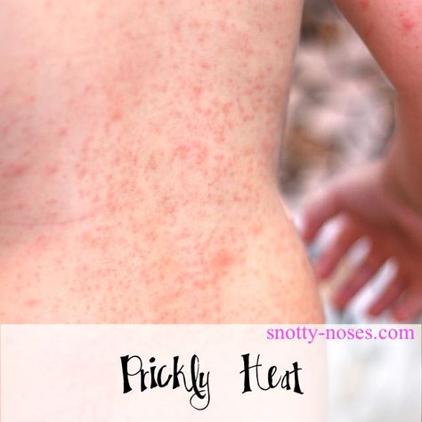 Prickly Heat Rash in Children by a pediatrician Remedies For Heat Rash, Heat Rash On Face, Treating Heat Rash, Baby Heat Rash, Heat Rash Remedy, Skin Rash Remedies, Home Remedies For Rashes, Prickly Heat Rash, Baby Skin Rash