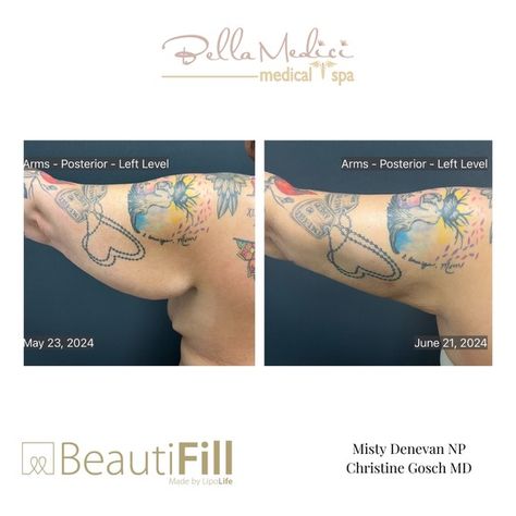 Can you imagine being able to have both the excess fat on the arms as well as the excell skin removed? 🫶🙌👍 Now you can! By combining Beautifill laser-assisted liposuction  With Beautifirm skin tightening you can get the same or better results without having the horrible scar! 👍😍👍 I know that sounds made up but it’s reality! Beautifill laser-assisted liposuction and Beautifirm skin-tightening together give the invasive look with two or three tiny incisions Lipo Before And After, Excess Skin, Medical Spa, Tummy Tucks, Health Diet, Skin Tightening, I Know, Diet, Skin