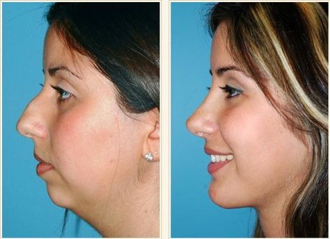 Non surgical chin augmentation newton ma no risks. Yes, this is the query to get some safe and vital possession for your chin augmentation. Jaw Reduction Surgery, Nose Plastic Surgery, Nose Surgery Rhinoplasty, Plastic Surgery Fail, Chin Augmentation, Rhinoplasty Nose Jobs, Plastic Surgery Gone Wrong, Face Surgery, Rhinoplasty Surgery