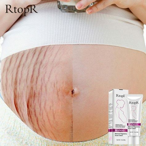 Shop eBay for great deals on Scar & Stretch Mark Reducers. You&apos;ll find new or used products in Scar & Stretch Mark Reducers on eBay. Free shipping on selected items. Stretch Mark Cream Pregnancy, Stretch Mark Removal Cream, Skin Repair Cream, Body Firming Cream, Marks Cream, Scar Removal Cream, Scar Cream, Body Firming, Stretch Mark Cream