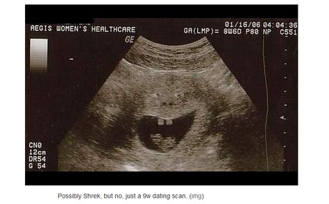 Check Out These Hilariously Funny Ultrasound Pictures of Unborn Babies Pregnancy Ultrasound, Funny Google Searches, Baby Ultrasound, Ultrasound Pictures, Unborn Baby, Ultrasound, X Ray, Funny Babies, Baby Pictures