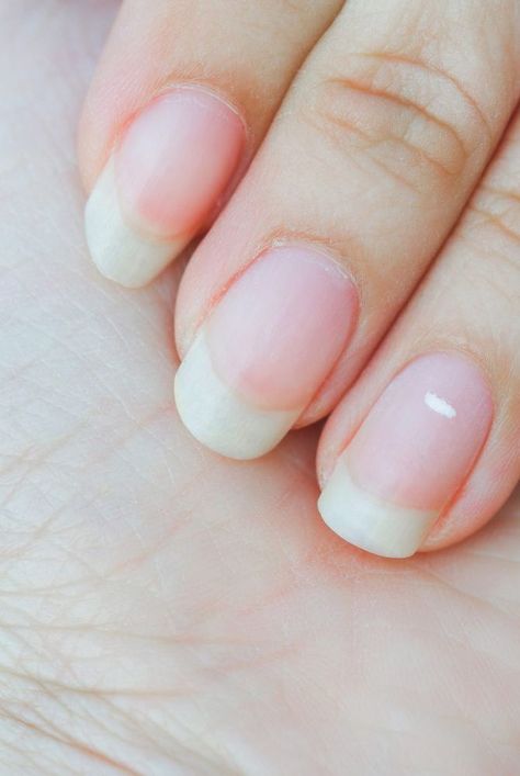 We asked experts what do white spots on nails mean, what causes white spots on nails, and how to get rid of white spots on nails. #realsimple#nailpolishideas#nailstrendingnow#trend#easynailpolishart#beautyhacks#beautydiy How To Get Rid Of White Spots On Nails, White Dots On Nails, White Spots On Fingernails, White Lines On Nails, White Marks On Nails, Nail Bed Damage, White Spots On Toenails, White Spots On Nails, Fingernail Health