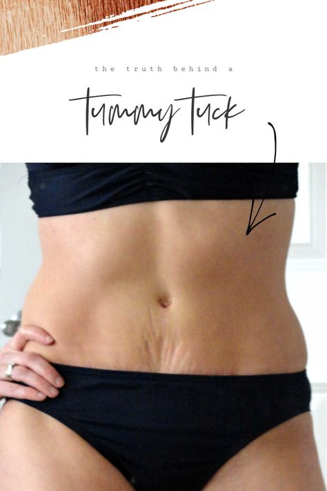 Mommy Makeover Workout, Hide Mommy Pouch Outfits, Tummy Tucks Before And After, Postpartum Tummy Tightening, How To Tighten Loose Skin On Stomach Mom, Tummy Tucks Tattoo Cover Up, After Birth Exercises Mummy Tummy, Tummy Tucks Recovery List, Mummy Makeover