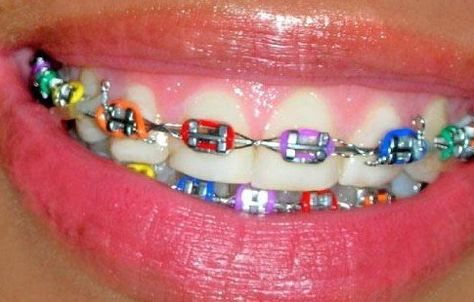 When you got your braces’ rubber band colors changed only to find out that someone else had the EXACT SAME COLORS. | 26 Moments That No '90s Kid Will Ever Get Over Rainbow Braces, Braces Rubber Bands, Cute Braces Colors, Braces Tips, Getting Braces, Cute Braces, Brace Face, Crooked Teeth, Braces Colors