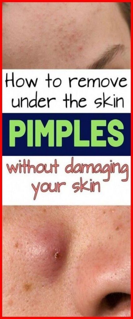 Pimple Meaning, Under The Skin Pimples, Blind Pimple, Get Rid Of Pimples, Rid Of Pimples, Pimples Under The Skin, Home Medicine, Body Coach, Health Articles Wellness