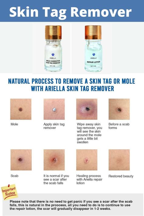 Remove Skin Tags, Remove Skin Tags Naturally, Tag Remover, Losing 40 Pounds, Mole Removal, Skin Tags, Home Remedy For Cough, Cold Sores Remedies, Natural Sleep Remedies