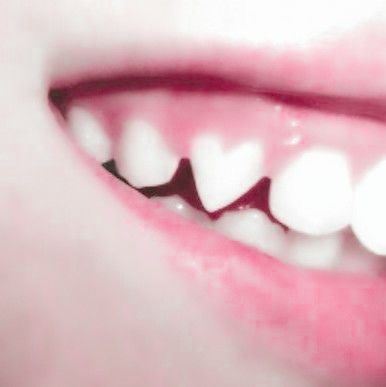 Heart Shaped Fangs Teeth, Specific Features Dr, Specific Features Claim Dr, Specific Features Claim, Monster High Aesthetic Draculaura, Mermaid Species, Aesthetic Draculaura, Monster High Aesthetic, Teeth Aesthetic