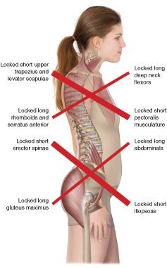 Upper Cross Syndrome, Lumbar Lordosis, Disk Herniation, Arteries And Veins, Pelvic Tilt, Pilates Teacher, Tight Hip Flexors, Tight Hips, Hip Flexor