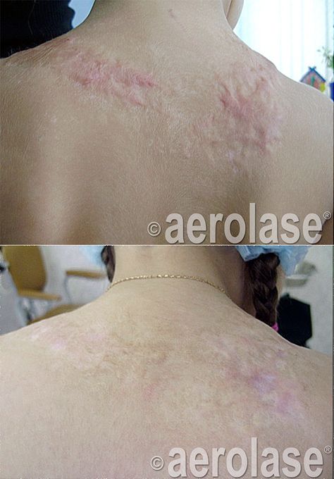 It's ‪#‎TransformationTuesday‬! Here is a before and after of a chemical burn victim being treated with our ‪#‎LightPodEra‬ laser for 2 treatments, these results are amazing! To learn more about our LightPodEra erbium laser device, head over to aerolase.com/products/lightpod-era/ or call 914.345.8300 for more information. #skincare #skin #scars #dermatology #medspa #beforeandafter Burn Reference, Burned Face, Erbium Laser, Frankenstein Makeup, Scar Makeup, Chemical Burn, Degree Burns, Joker Makeup, Skin Burns