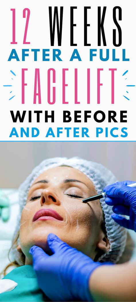 The finale, Part 4, of Erin's facelift journey, shows the before and afters of her facelift 12 weeks post-surgery. Plus, she dishes on all the things she learned and the best tips if you're looking to have some cosmetic surgery done. #cosmeticsurgery #facelift #plasticsurgery #skincare Facelift Recovery Day By Day, Facelift Recovery, Facelift Before And After, Plastic Surgery Fail, Plastic Surgery Gone Wrong, Face Lift Surgery, Face Wrap, Celebrity Plastic Surgery, Tarot Card Readers