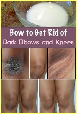 Dark Elbows And Knees, Dark Knees, Dark Elbows, Skin Care Routine For 20s, Black Skin Care, Beauty Remedies, Skin Remedies, Skin Care Remedies, Whitening Cream