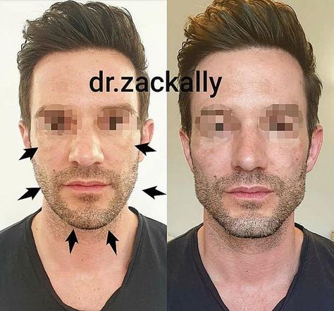 ☝️MASCULINISATION (7ml) ▪▪▪▪▪▪▪▪▪▪▪▪▪▪▪▪▪▪ Before and 15 minutes after cheeks, chin, jawline and mandibular angle augmentation creating a… Jawline Filler, Strong Chin, Chin Filler, Strong Jawline, Famous Celebrities, Round Sunglass Men, Plastic Surgery, 15 Minutes, Mens Hairstyles