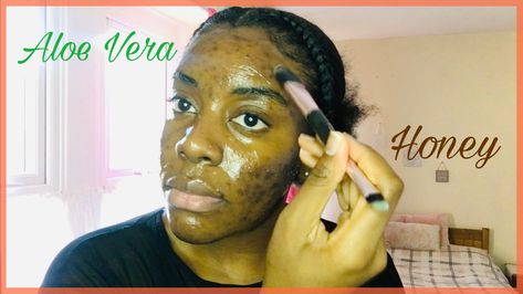 Diy Aloe Vera Face Mask, Face Masks For Acne, Masks For Acne, Honey For Acne, Sunburn Peeling, Aloe Vera Face, Aloe On Face, Acne Hyperpigmentation, Organic Aloe Vera Gel