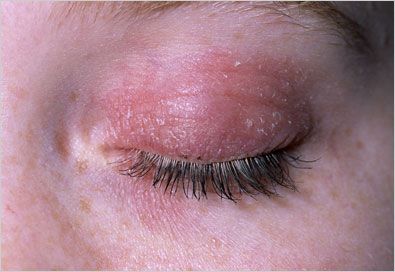 How To Get Rid Of Dry Red Skin On Eyelids Dry Flaky Eyelids, Flaky Skin On Face, Itchy Eyelids, Dry Skin Around Eyes, Swollen Feet Remedies, Dry Eyelids, Allergies Remedies, Feet Remedies, Vitamin C Skincare