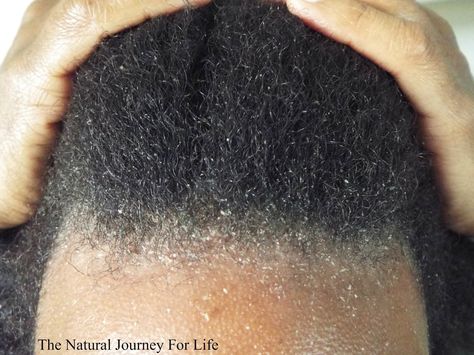 Dry Flaky Scalp, Dandruff Remedy, Cradle Cap, Flaky Scalp, Skin Oil, Hair Dandruff, Skin Condition, Dry Scalp, Hair Problems