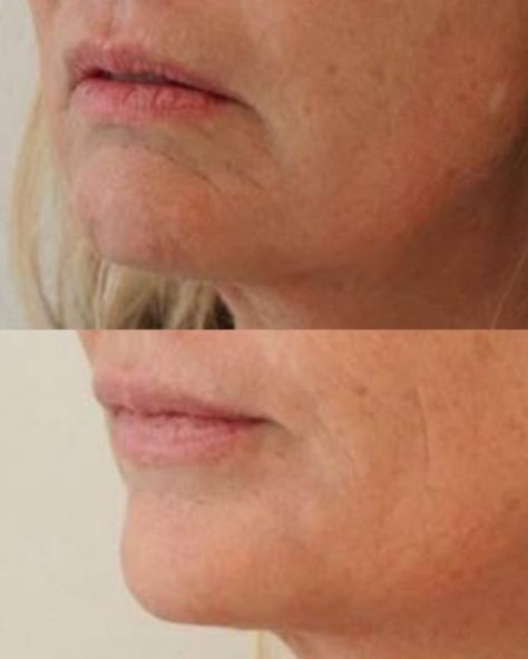 Injections for DAO Muscle | Downturned mouth - Best Clinic Sydney for Dermal Fillers Downturned Mouth, Chin Wrinkles, Marionette Lines, Mild Acne, Fractional Laser, Numbing Cream, Cosmetic Clinic, Dermal Fillers, Muscle Relaxer