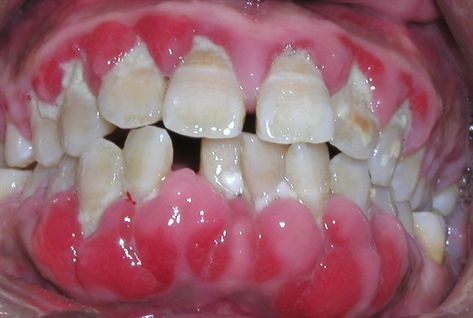 Dental Room, Dental Spa, Dental Tips, Rare Disorders, Dental Life, Painting References, Scary Things, Periodontal Disease, Patient Education