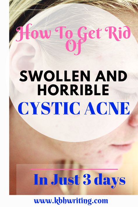 Get Rid Of Cystic Acne, Cystic Acne On Chin, Treating Cystic Acne, Cystic Pimple, Cystic Acne Remedies, Forehead Acne, Acne Overnight, Pimples Overnight, Natural Acne Remedies