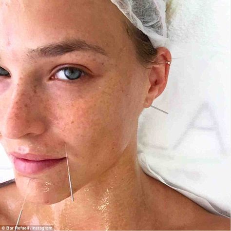 Treating herself: Bar Refaeli took time out to relax with some acupuncture on Monday and posted the picture of herself with needles sticking out of her face to Instagram Moxa Therapy, Facial Acupuncture, Collagen Rich Foods, Diy Massage Oil, Botox Brow Lift, Tips For Dark Circles, Asian Medicine, Facial Gua Sha, Natural Botox