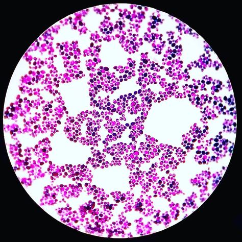 Candida albicans Gram stain. Measure Bra Size, Candida Albicans, The Patient, Microbiology, Anti Social, Yeast, Biology, New Work, Stain