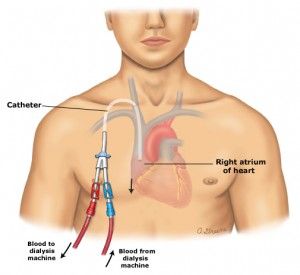 CLABSI: Central Line Associated Blood Stream Infection. Follow our blogs to stay up to date on the latest case studies and statistics about CLABSI and patients. #ZeroInfection #Patients #CVCHealthCare #CLABSI #Educating Central Venous Catheter, Central Line, Infection Prevention, Nursing School Notes, Nursing Tips, Nursing Career, Medical Field, Tampa Fl, Patient Care