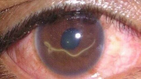 He gave us eyes to see them........                               Loa loa Eye Worm, Human Oddities, Unusual Things, Medical Science, Medical History, Medical Conditions, An Eye, Disease, Fun Facts